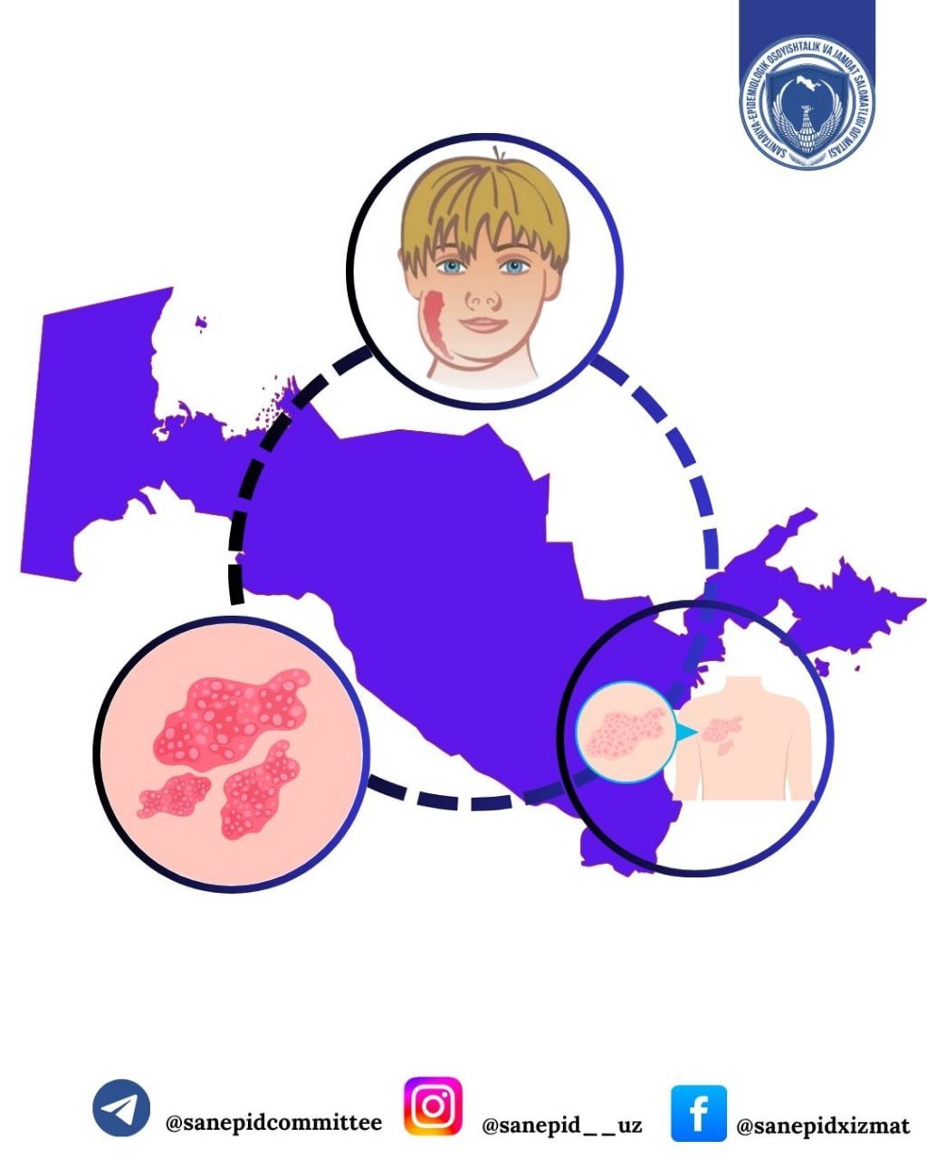 Tepki asosan bolalar kasallanadigan virusli yuqumli kasallik