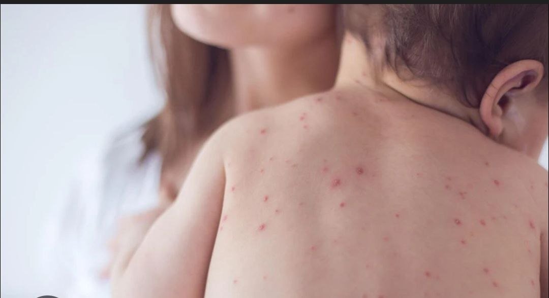 Qizamiq asorati bilan xavfli