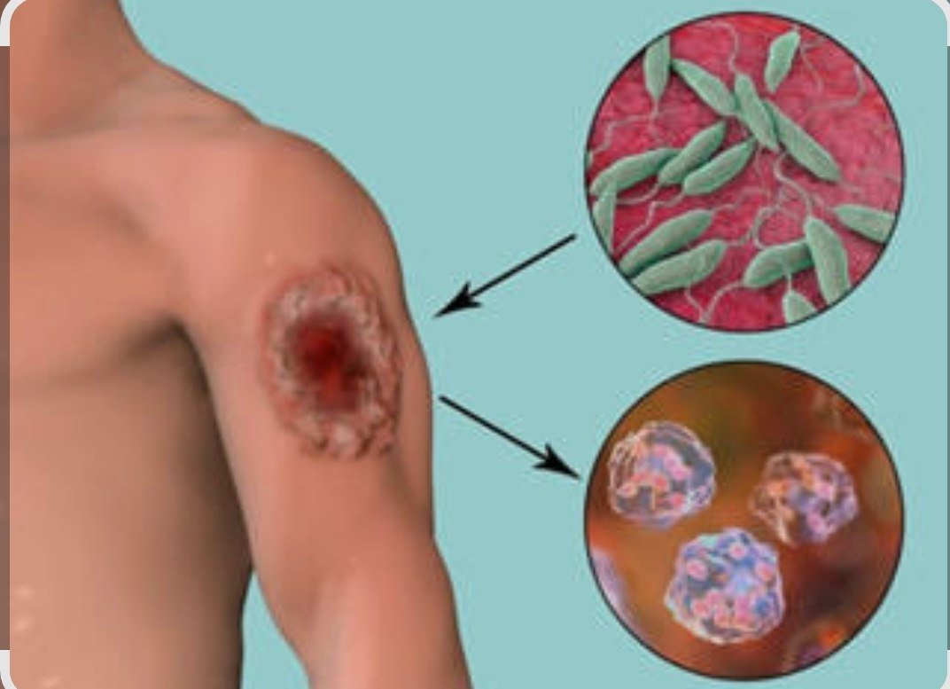Leyshmanioz kasalligi qanday tarqaladi ?